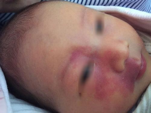 婴幼儿血管瘤会自行消退？小心长在这些部位的“瘤”，或危及生命