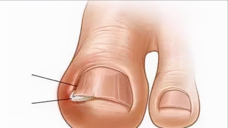 指甲往肉里长怎么办,指甲老往肉里钻