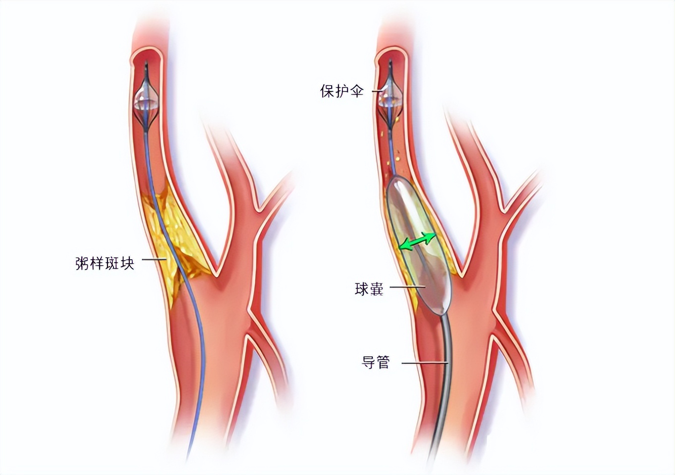 脑梗患者舌底取栓,脑梗取栓是最佳治疗方法吗