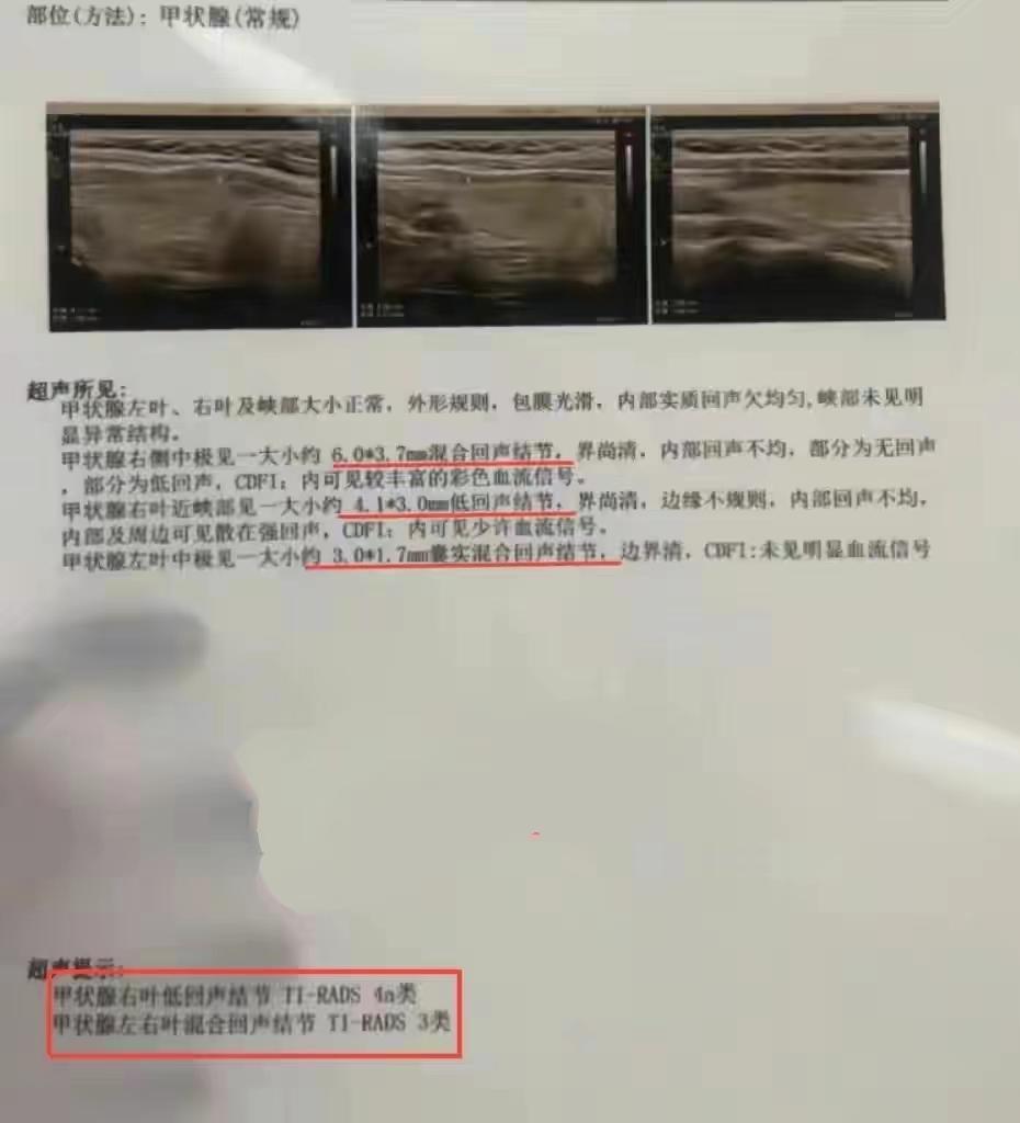 甲状腺恶性结节切除正常可活几年,为什么甲状腺结节不建议手术呢