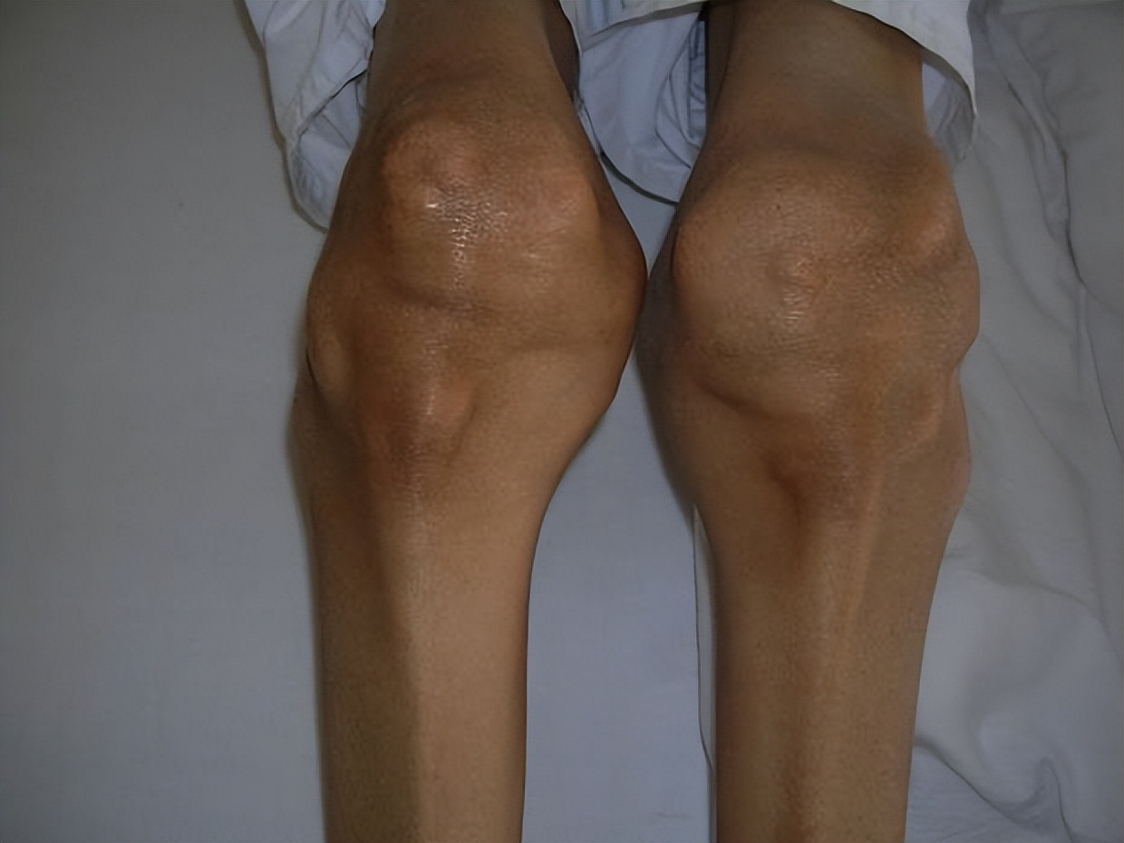 膝关节痛风疼的症状,膝关节痛风什么症状