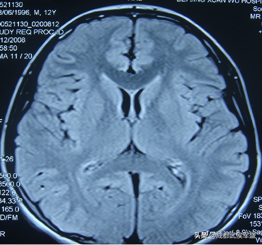什么类型的癫痫比较好治疗,癫痫的手术治疗方法有什么