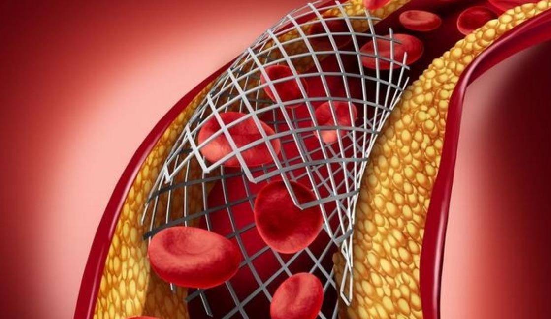 医生科普常见的5种心血管疾病,高死亡率的疾病