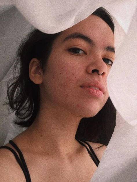 假期治痘最佳时期,如何快速消除熬夜痘