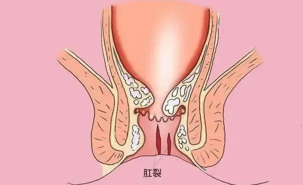 痔疮便血和肛裂便血的区别,女性痔疮肛裂便血左下腹疼