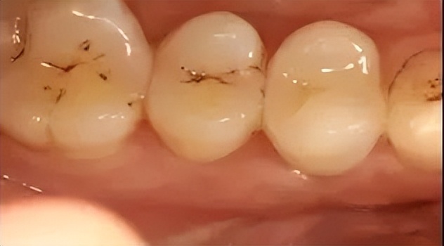 补牙跟嵌体有什么区别哪个更牢固,补牙为什么非要根管