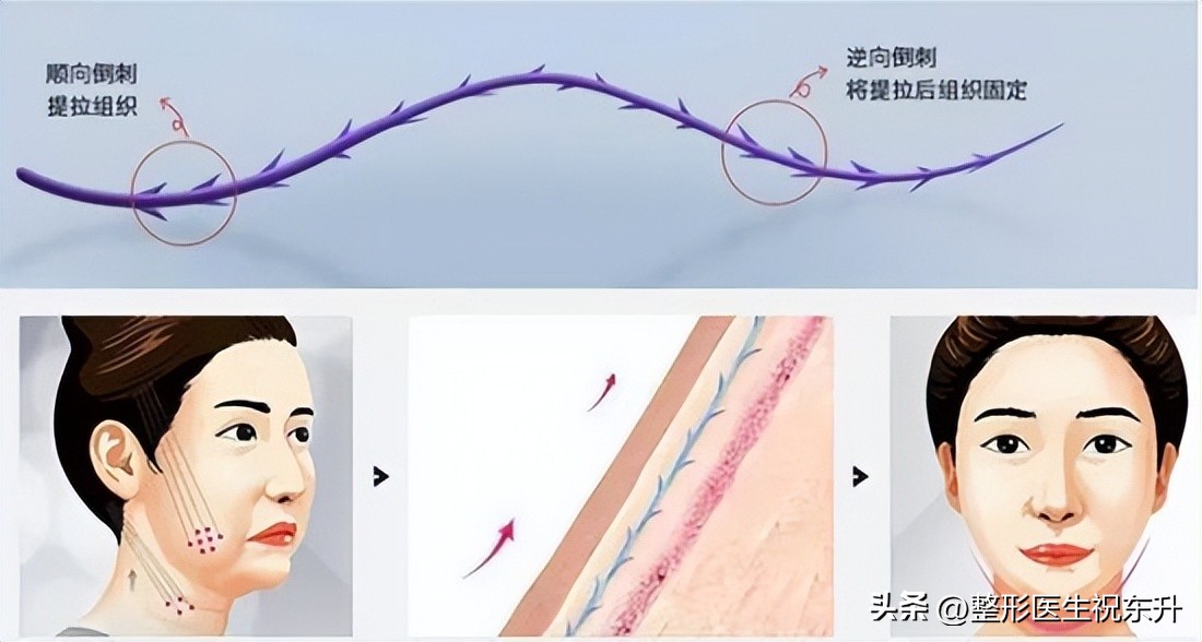 面部年轻化项目,面部年轻化案例