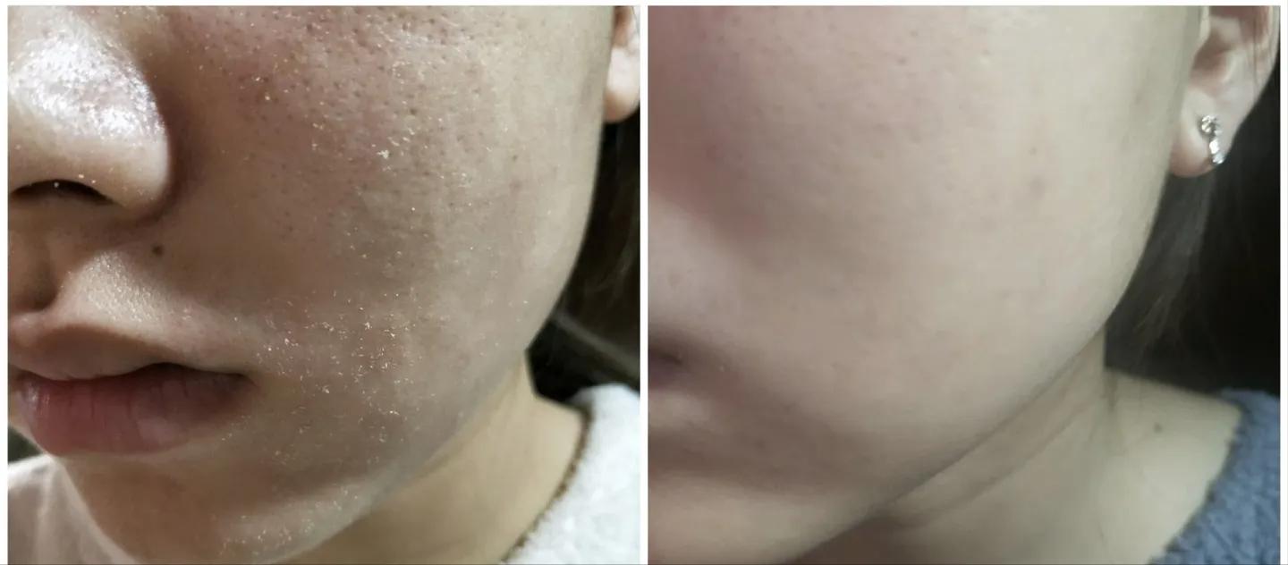 为什么用完洗面奶脸部泛红起皮,为什么用完洗面奶后脸更黑了