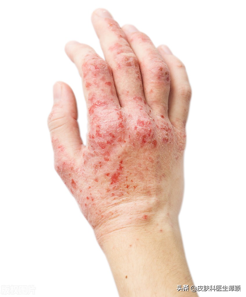 皮肤科医生痱子和湿疹的区别,皮肤科医生如何诊断你是湿疹