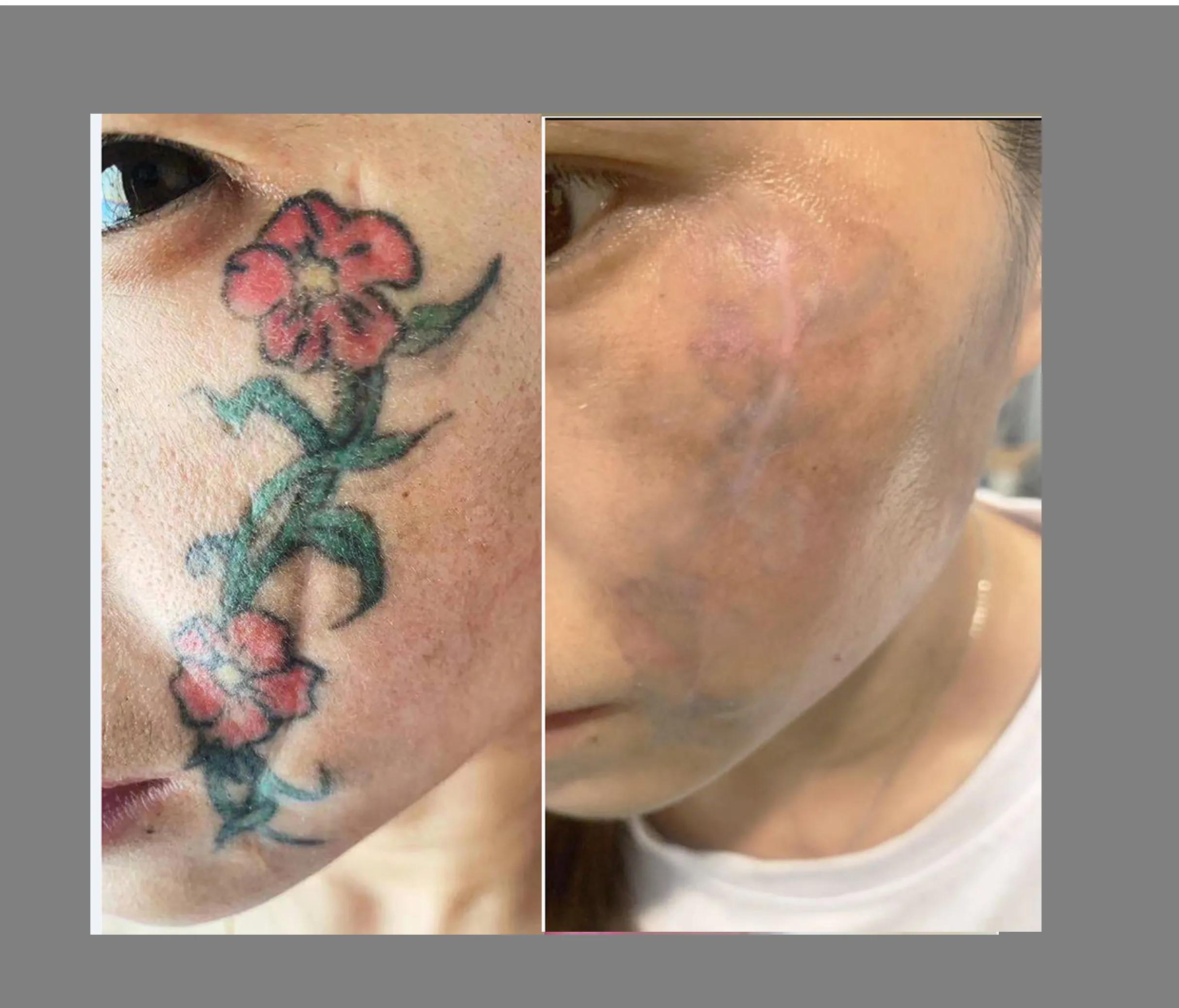 洗纹身真的不是一般人能承受的,洗纹身真的要下很大的决心