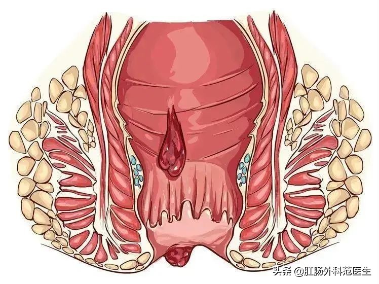 肛裂的治疗目的不包括,肛裂的治疗口服药物