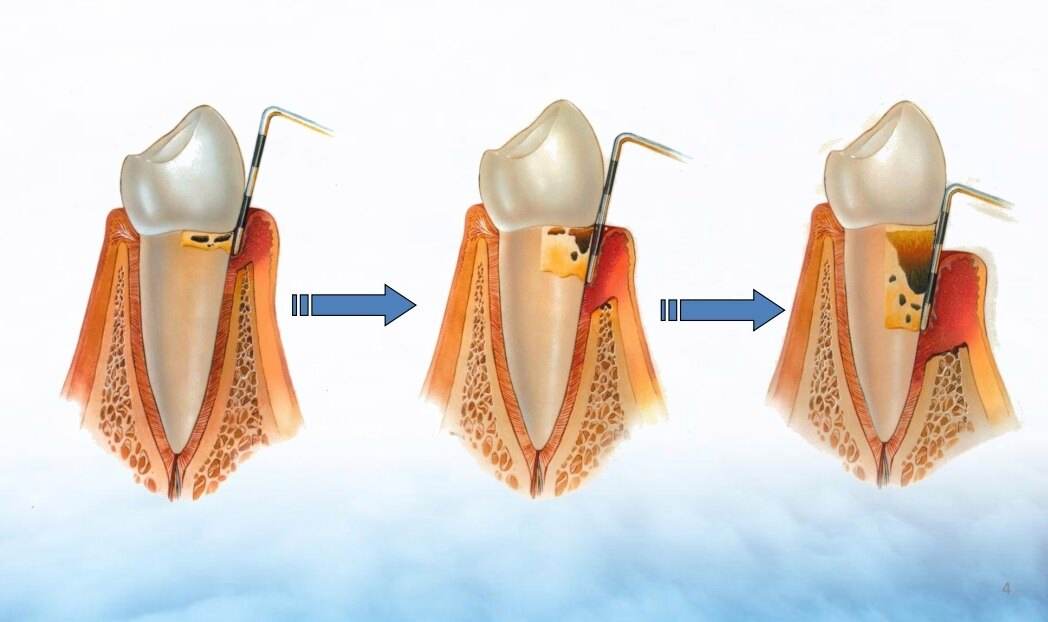 半夜出现牙疼和后背疼,牙出现大洞牙疼怎么办