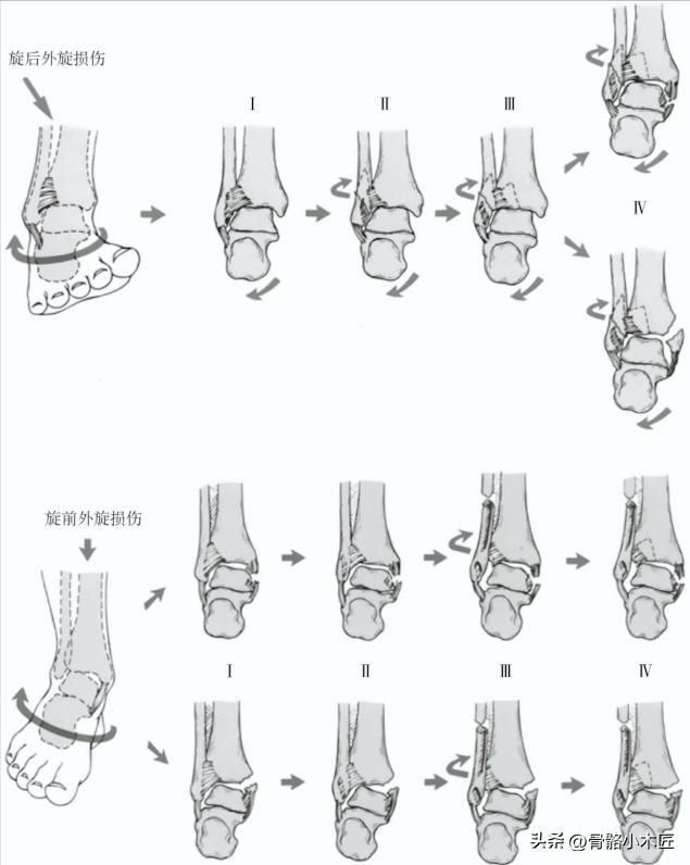 踝部骨折属于几级伤残,踝部骨折多久可以下地