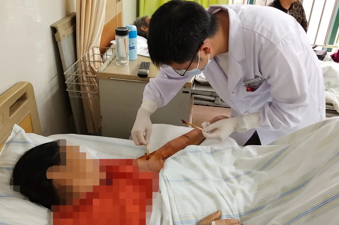 血管造瘘透析,血管人工搭桥