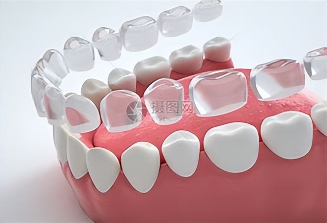 关于牙齿正畸矫正的过程,牙齿矫正的具体流程是什么