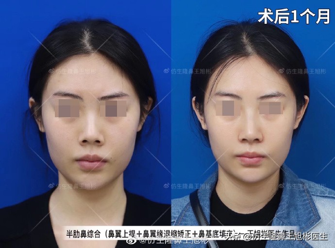 常见鼻部整形美容项目,整形鼻和自然鼻