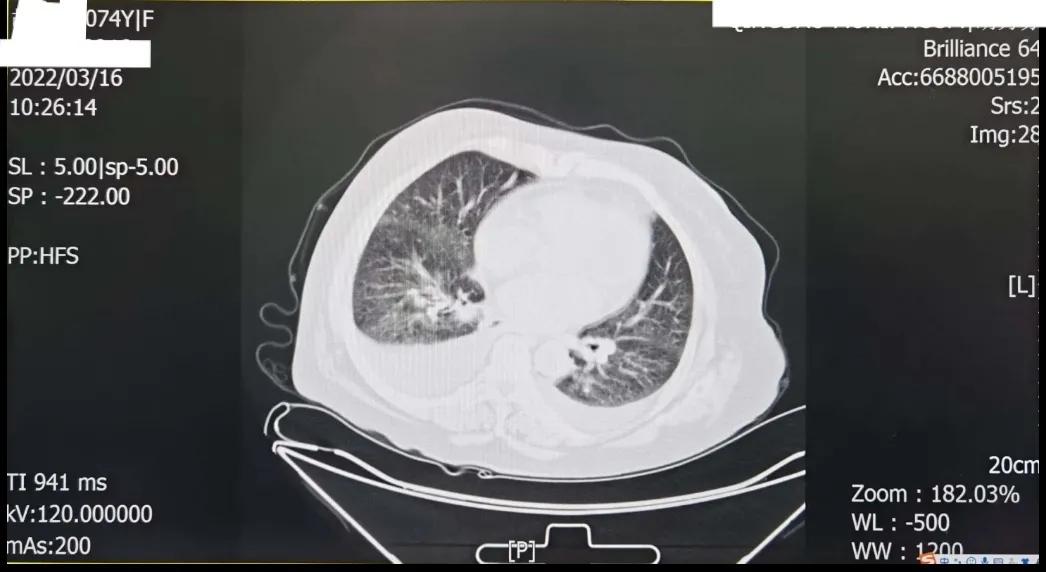 双下肢水肿心源性,心衰双下肢水肿