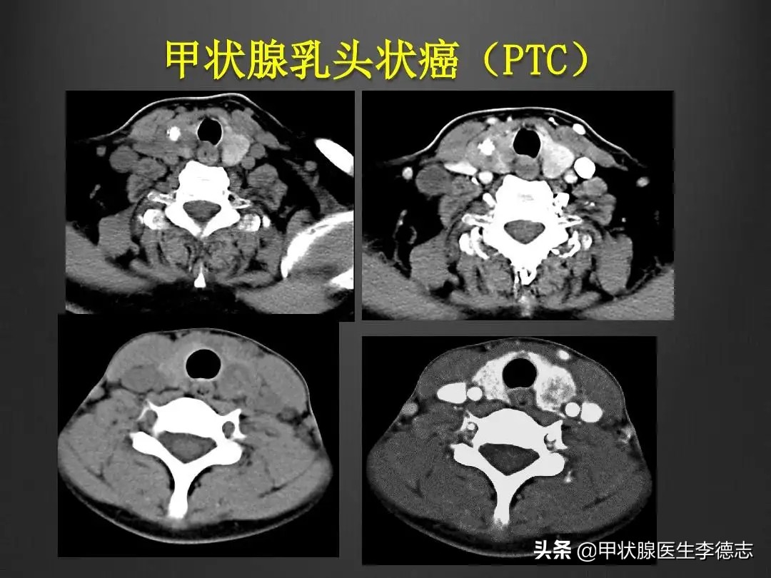 甲状腺癌实例,甲状腺乳头状癌半切和全切