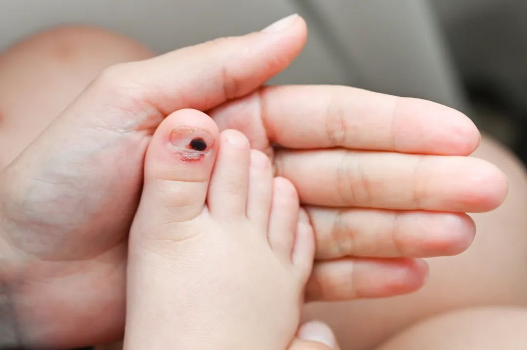 灰指甲不痛不痒是不是严重,灰指甲不痛不痒可以不治疗吗