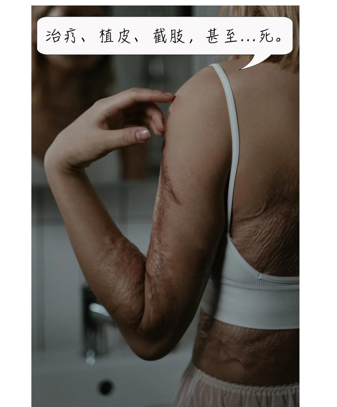 “我女儿3岁，今年要上幼儿园，被开水烫了一身，全家欠一屁股债”