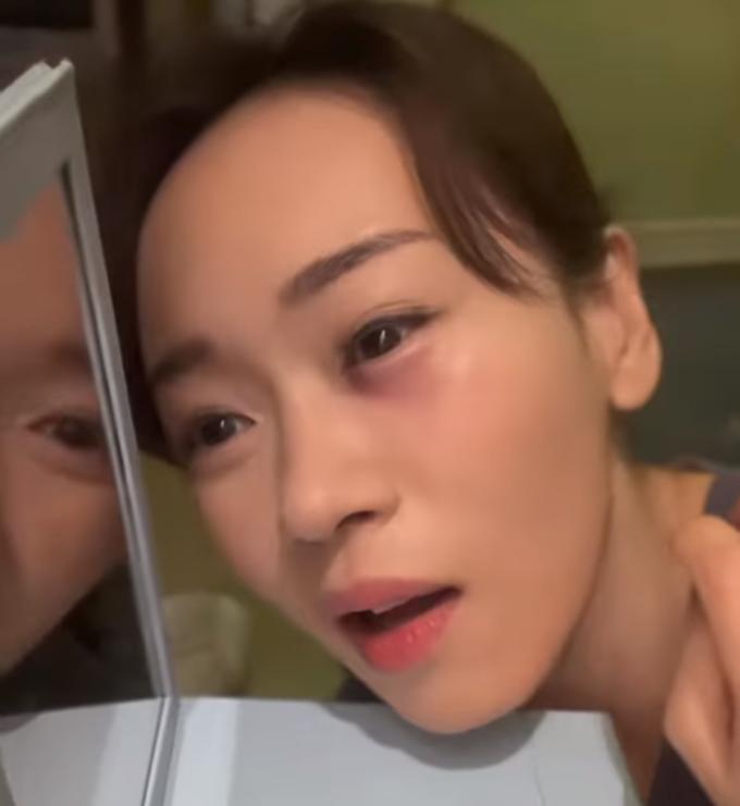 女演员拍戏弄伤眼睛,台湾女演员拍摄时被毁容