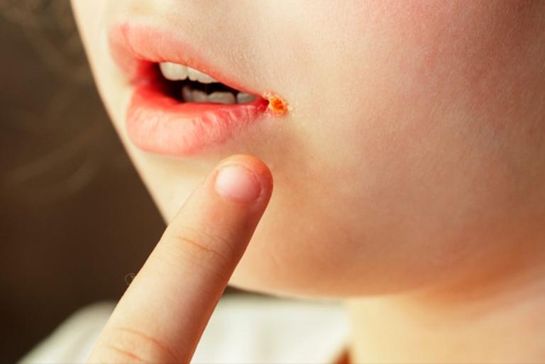 嘴唇疱疹和口角炎的区别,嘴角长疱疹嘴唇起泡结痂红肿