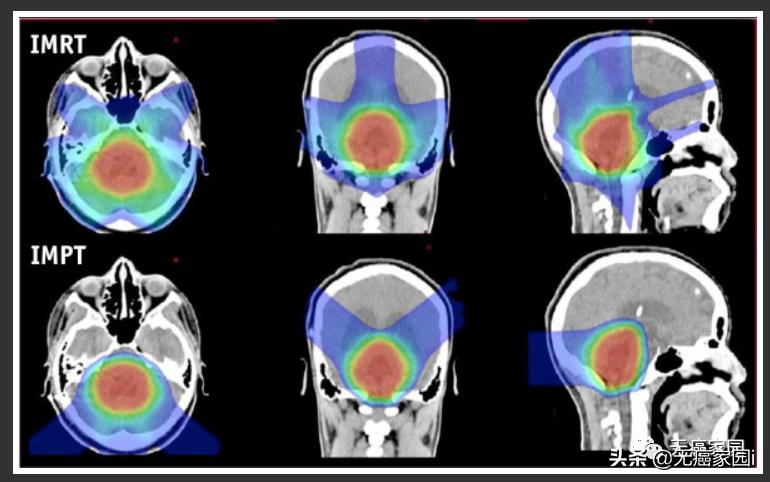 儿童弥漫性胶质瘤和胶质母细胞瘤,儿童胶质母细胞肿瘤