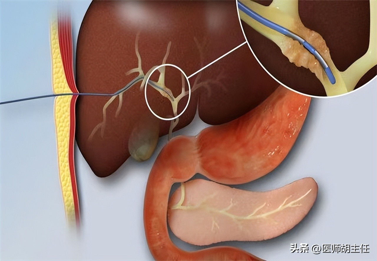 肝病胆红素偏高怎么才能降下来,体检胆红素偏高怎么快速降低