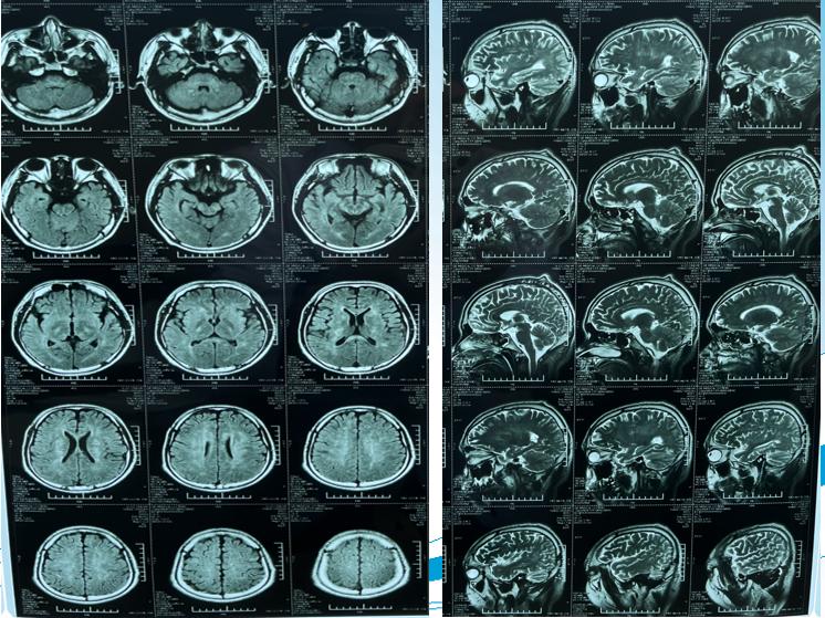 世界脑膜炎日是哪一天,世界脊髓灰质炎日