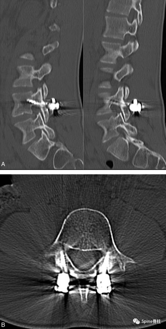 峡部裂和隐性峡部裂有区别吗,单纯峡部裂可以做峡部修复吗
