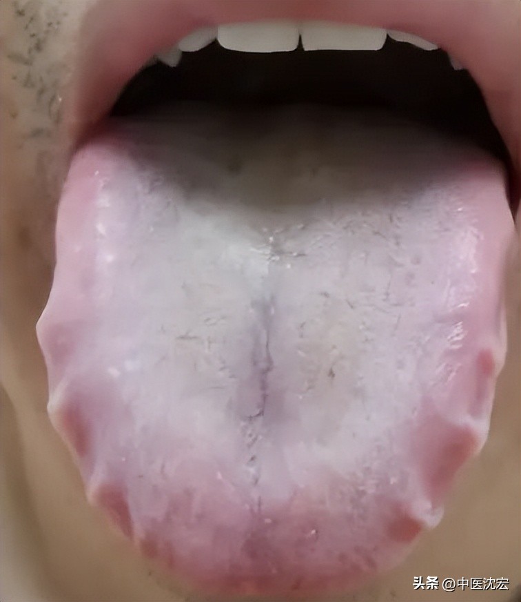 舌红舌头胖,舌暗红但舌苔很白是寒是热