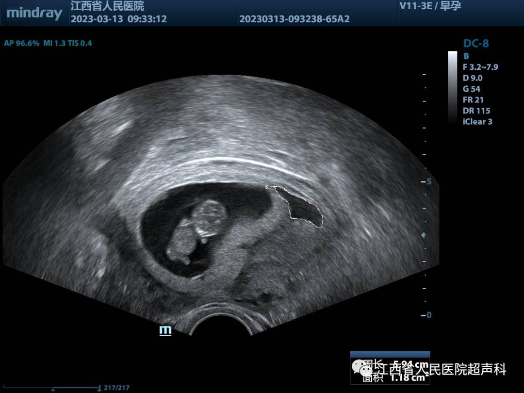 宫腔积液保胎成功的10大征兆,孕囊旁积液饮食