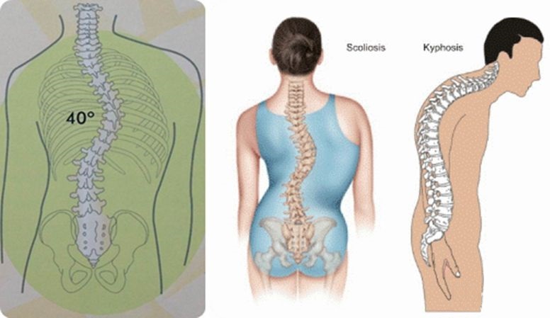 脊柱侧弯保守治疗可以报销吗,脊柱侧弯手术15万能报销多少