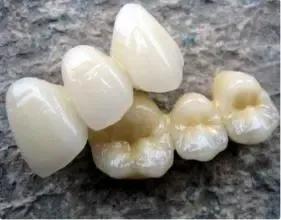 一分钟带你了解各种假牙,假牙基础知识