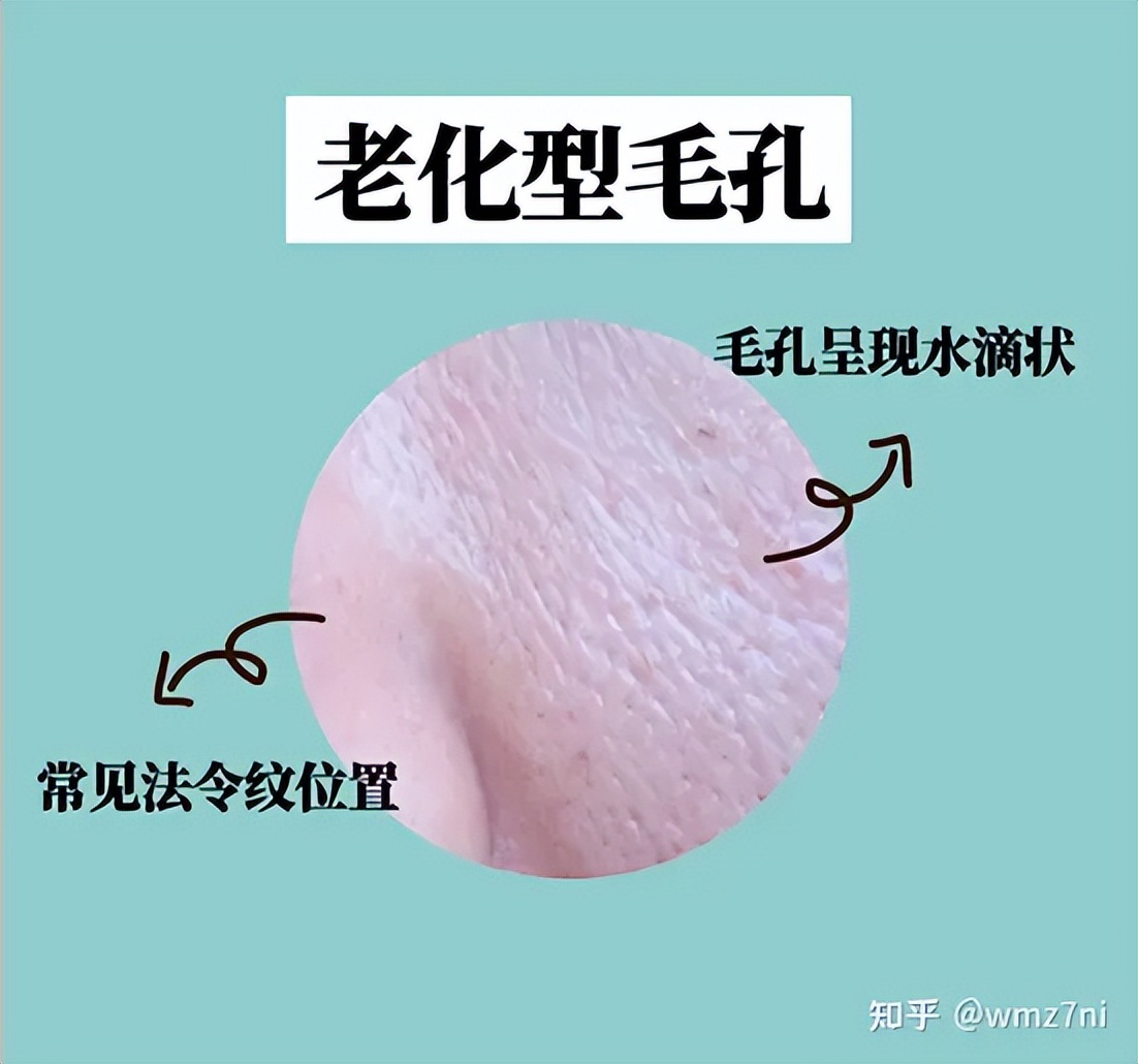 毛孔粗大的三大类型你属于哪一种,几种类型毛孔粗大改善的方法