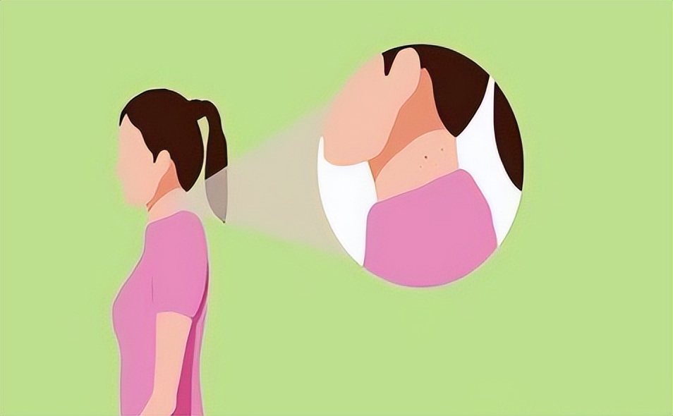 脖子腋下的小肉粒是什么,脖子腋下长小肉粒可以用手揪掉吗