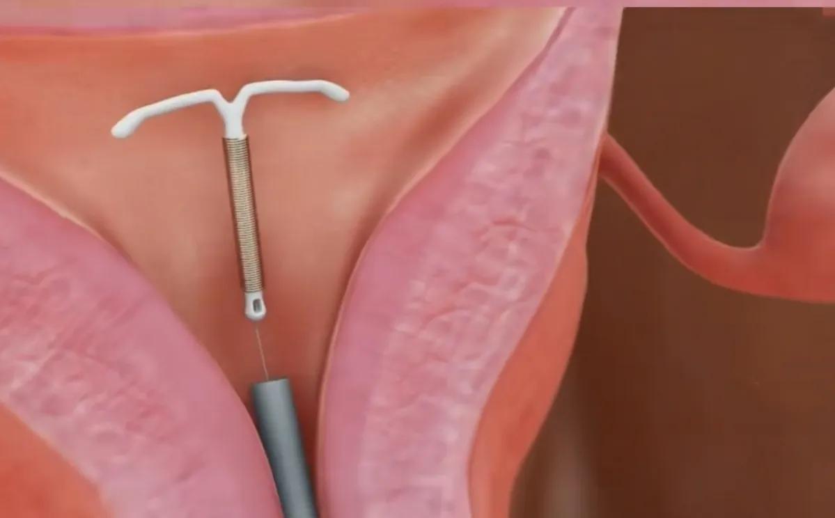 植入式避孕棒的优缺点,有哪些避孕措施与优缺点