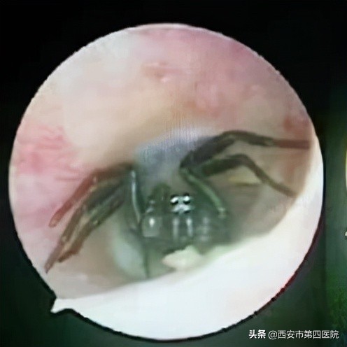 6岁男孩把橡皮擦塞耳朵里怎么办,小孩子用棉签把耳朵给弄流血了