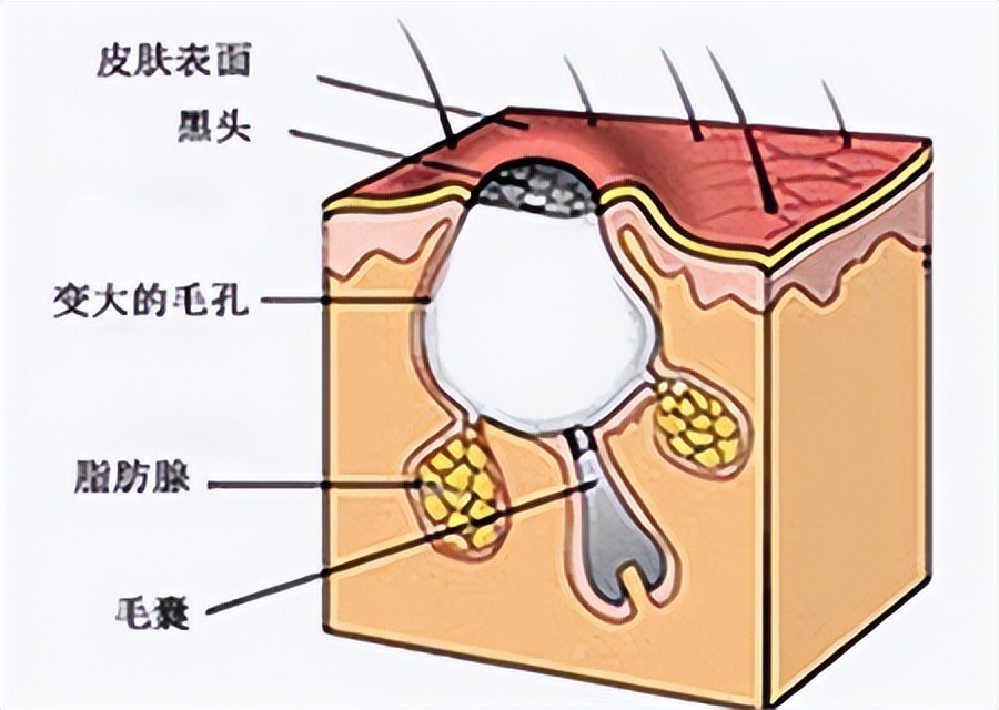 头皮长疙瘩怎么回事怎么解决,头皮上长疙瘩怎么治疗彻底