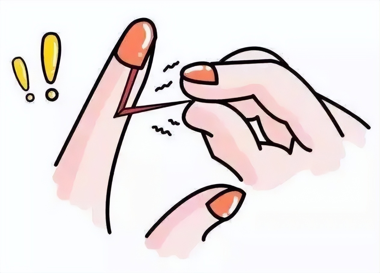 手指上的倒刺怎样快速去除,手指上出了倒刺怎么解决