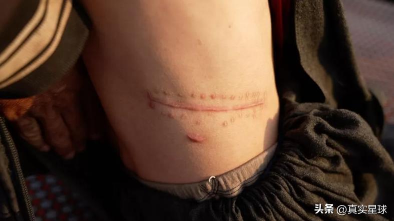 绝望阿富汗！人民排队挨刀卖肾，给婴儿吃镇定剂当饭，卖子女还债