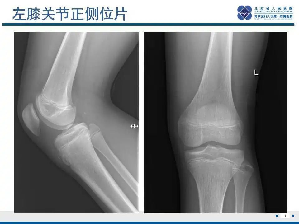 胫骨结节软骨炎要怎么治疗,胫骨结节骨软骨炎会癌变吗