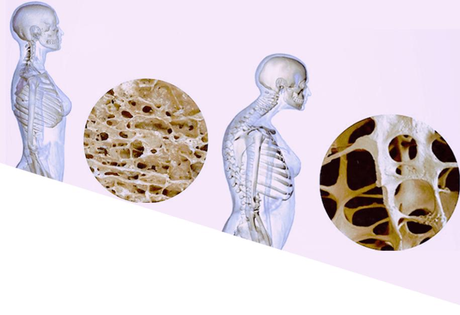 儿童骨密度检测中bmi正常范围,34岁骨密度检测说骨质疏松怎么办