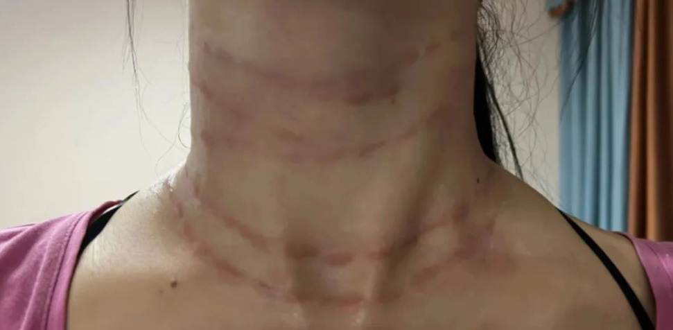 打完嗨体颈纹凸起一月,打了四针颈纹凸起