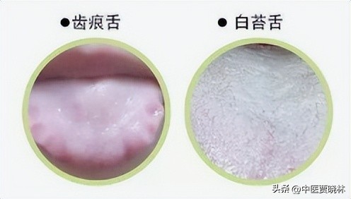 舌有齿痕属于哪一种湿气,舌边有齿痕一定是体内湿气吗