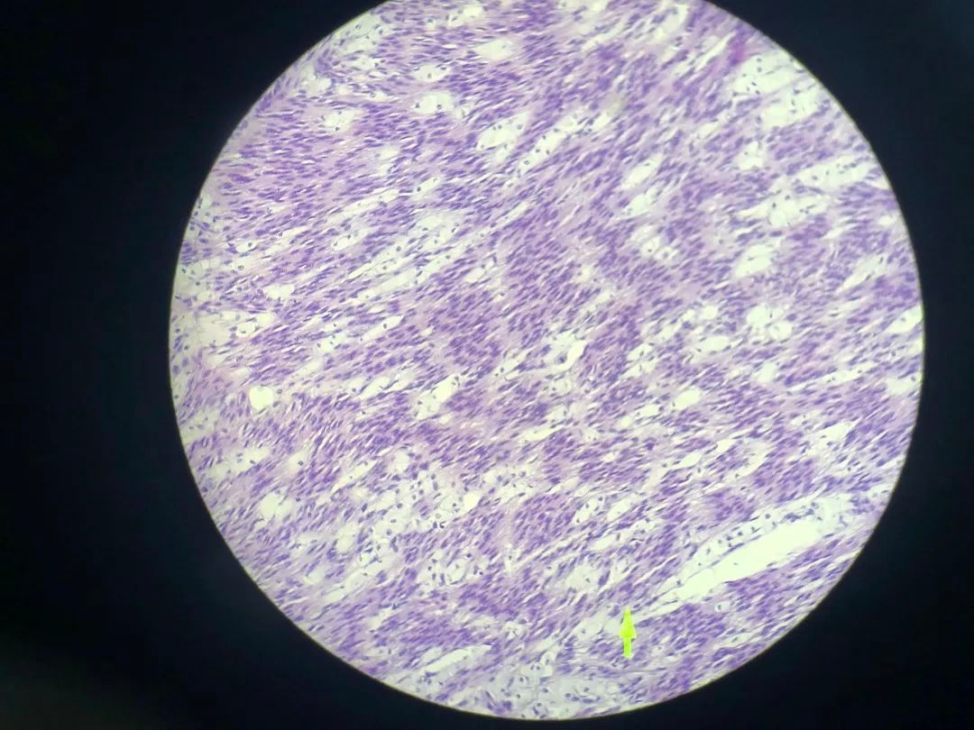 医生说病理报告有点小问题,病理报告没出来好害怕啊