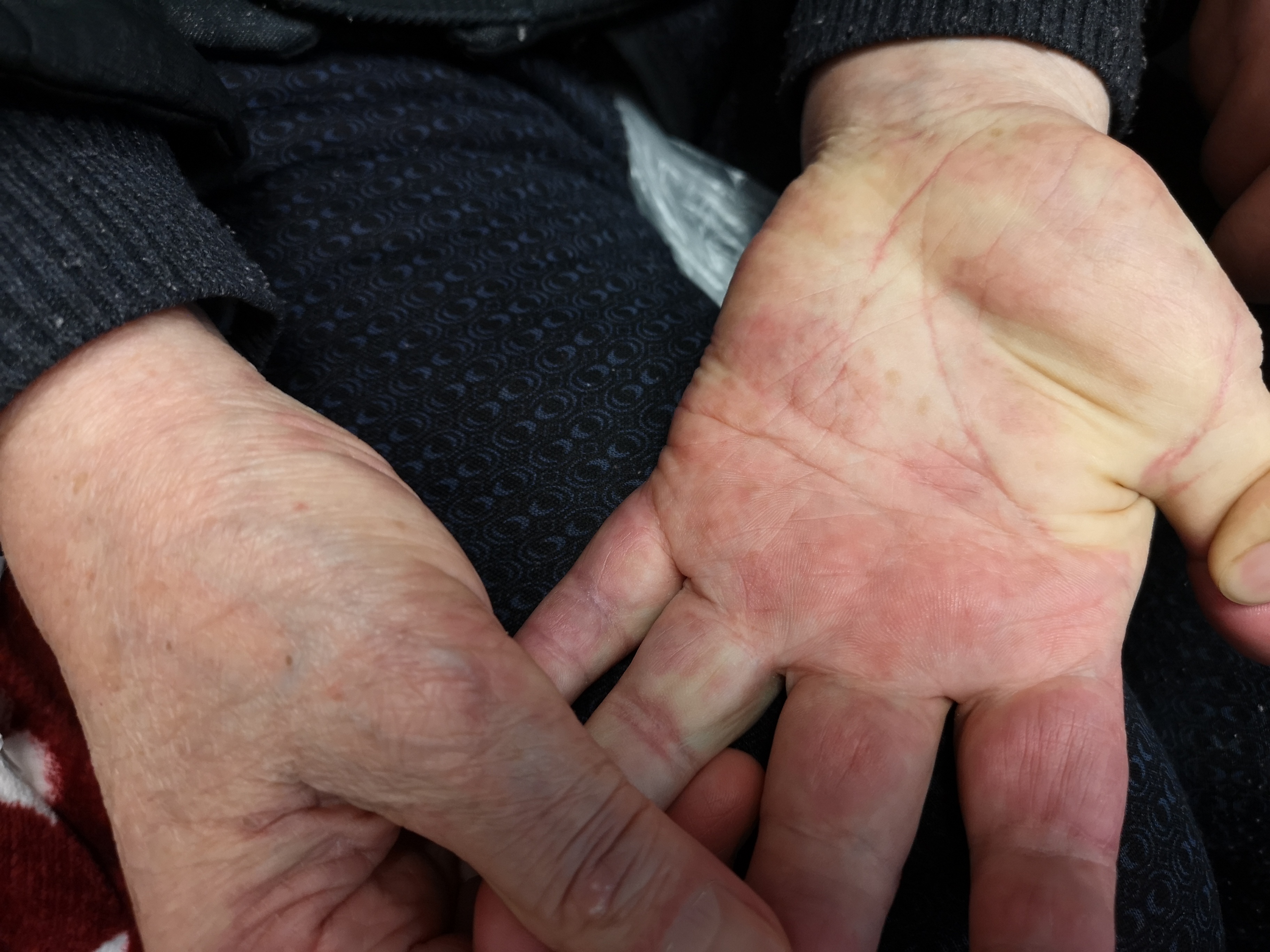 对镍过敏是怎么回事,镍过敏的人多不多