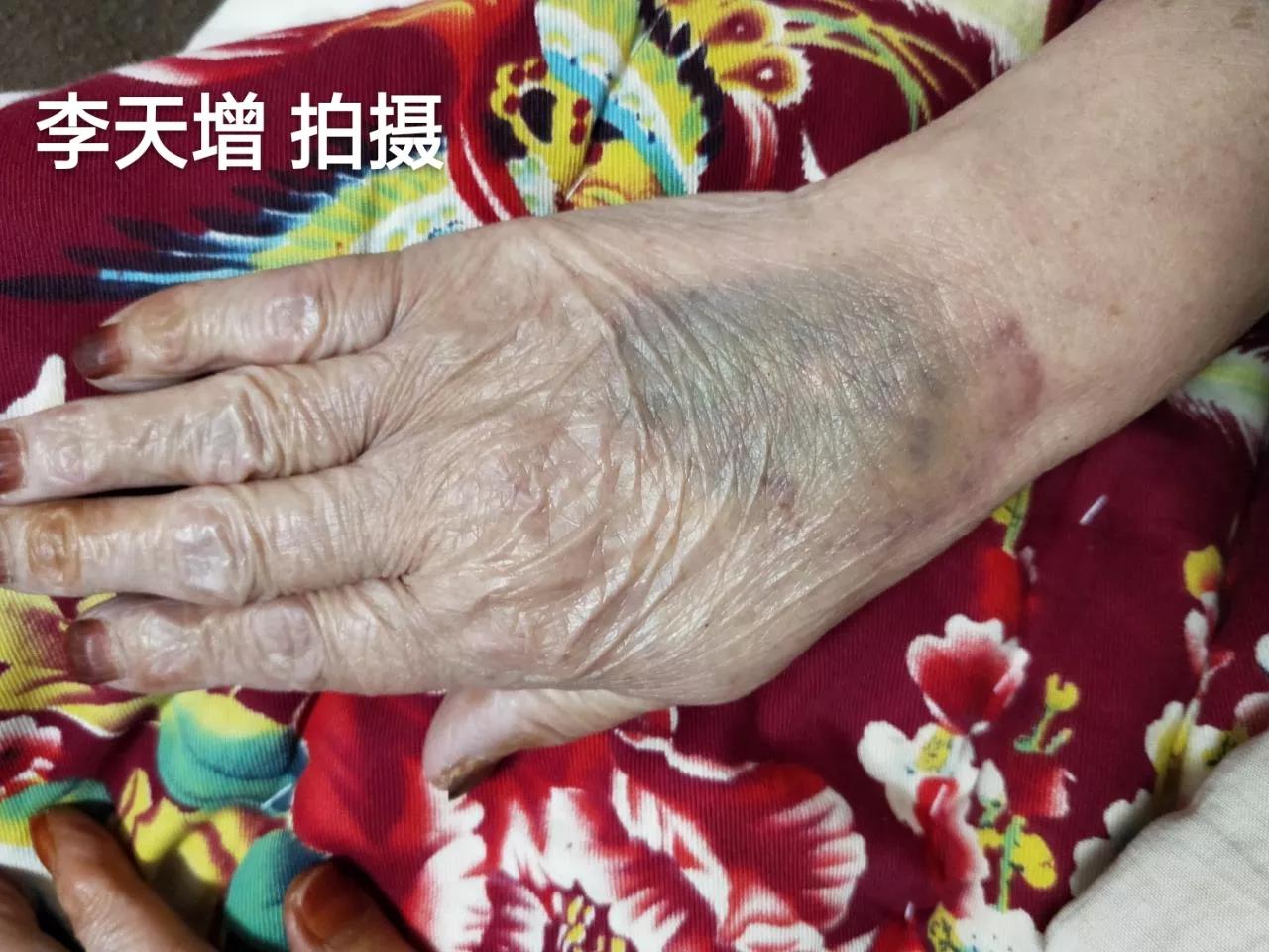 40岁女性手背开始很多皱纹怎么办,手背皮肤松弛皱纹多粗糙是啥原因