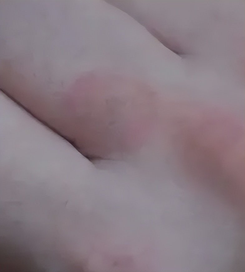 猫咪得猫癣人怎么办,猫咪得了猫癣人怎么办