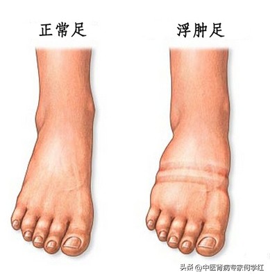 肾病综合症水肿是什么原因导致的,肾病综合症打了单抗水肿